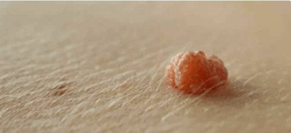 Papillar virus