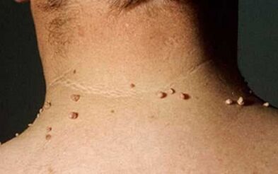 Causes of papilloma