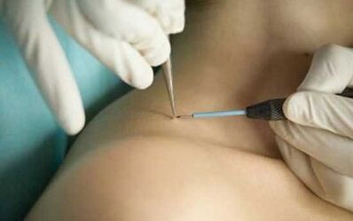 Papilloma removal method