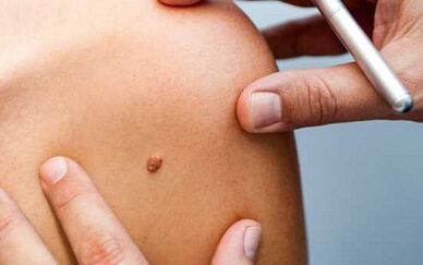 Treatment methods for papilloma