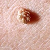 Human papillomavirus on the skin