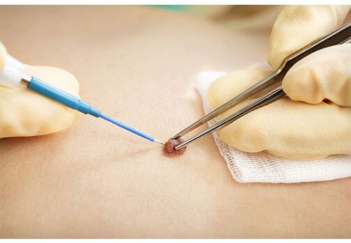 Remove papilloma