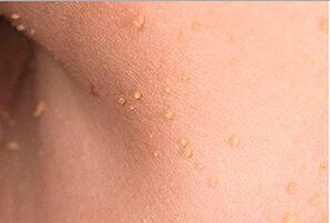 What is a papilloma on the body