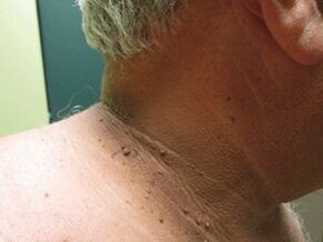 Causes of plural nipples in the body