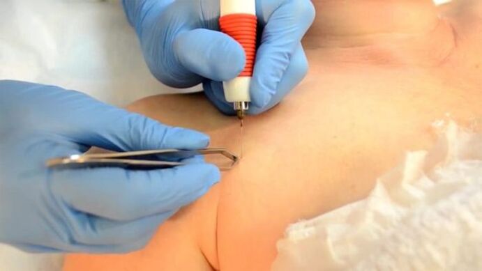 Electrocoagulation - a method of removing papillomas