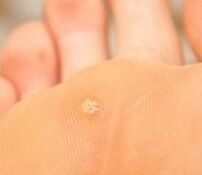 Causes of plantar warts