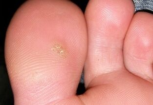 How to remove plantar warts