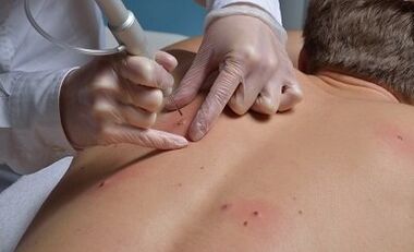 How to remove papillomas