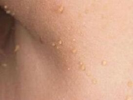 Causes of Papillomas in the Body