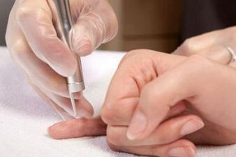 How to remove papillomas from the body