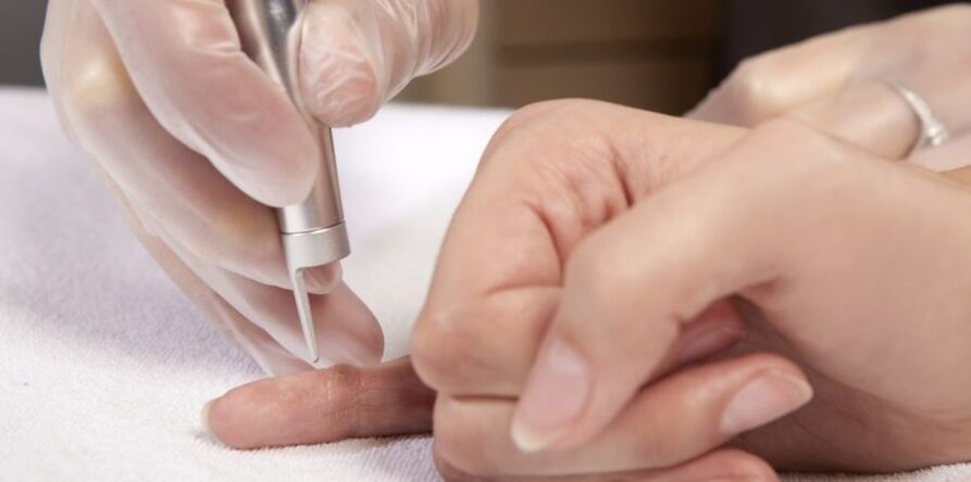 How to remove papillomas on hands and their dangers