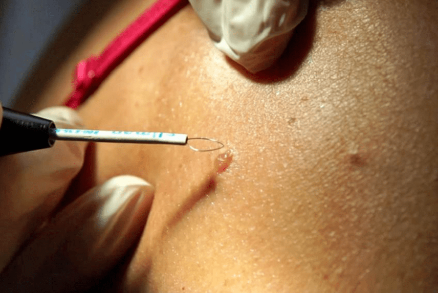 The professional way to remove papillomas
