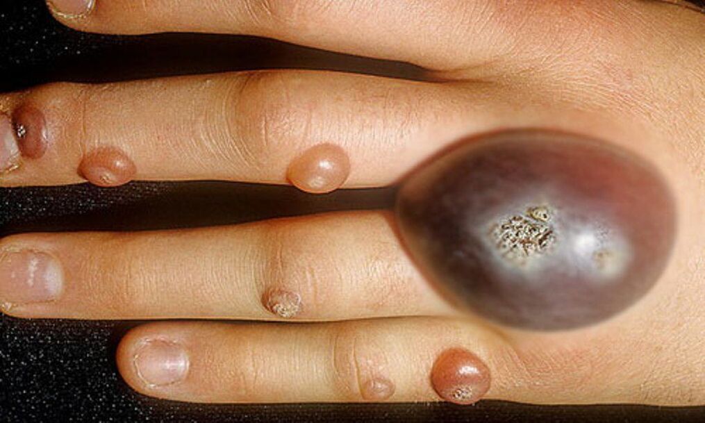 Big warts on hands