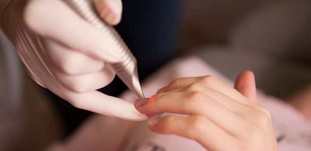 Laser treatment for warts