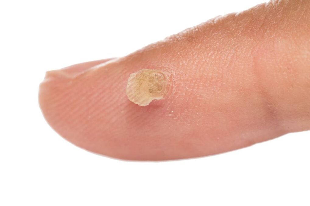 warts on fingers