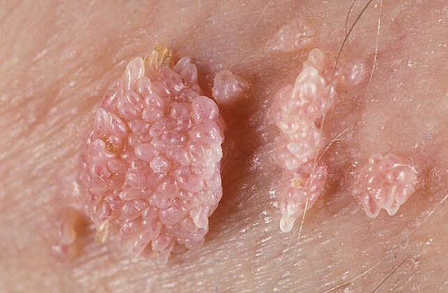 Papillomas are benign tumor-like formations of the skin and mucous membranes that have a verrucous nature