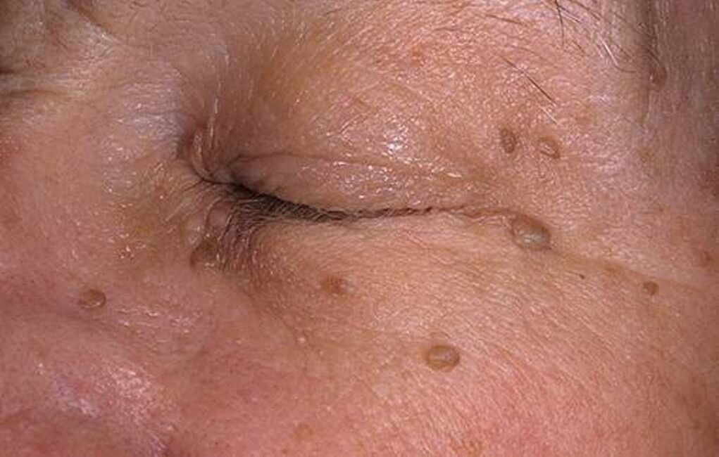 papilloma on facial skin