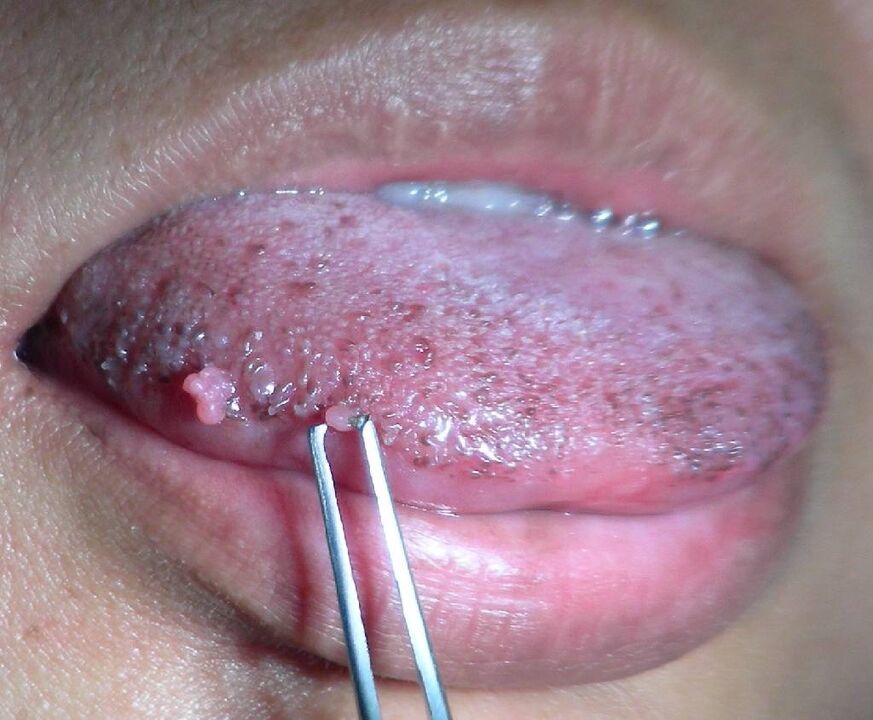papilloma on tongue